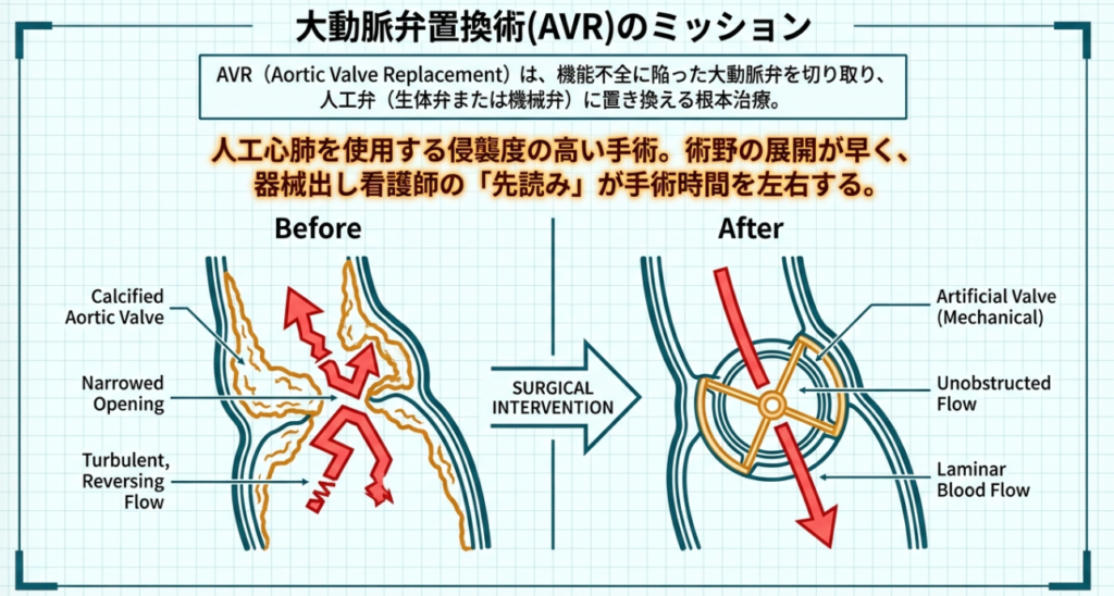 大動脈弁置換術(AVR)とは?基礎知識の解説画像