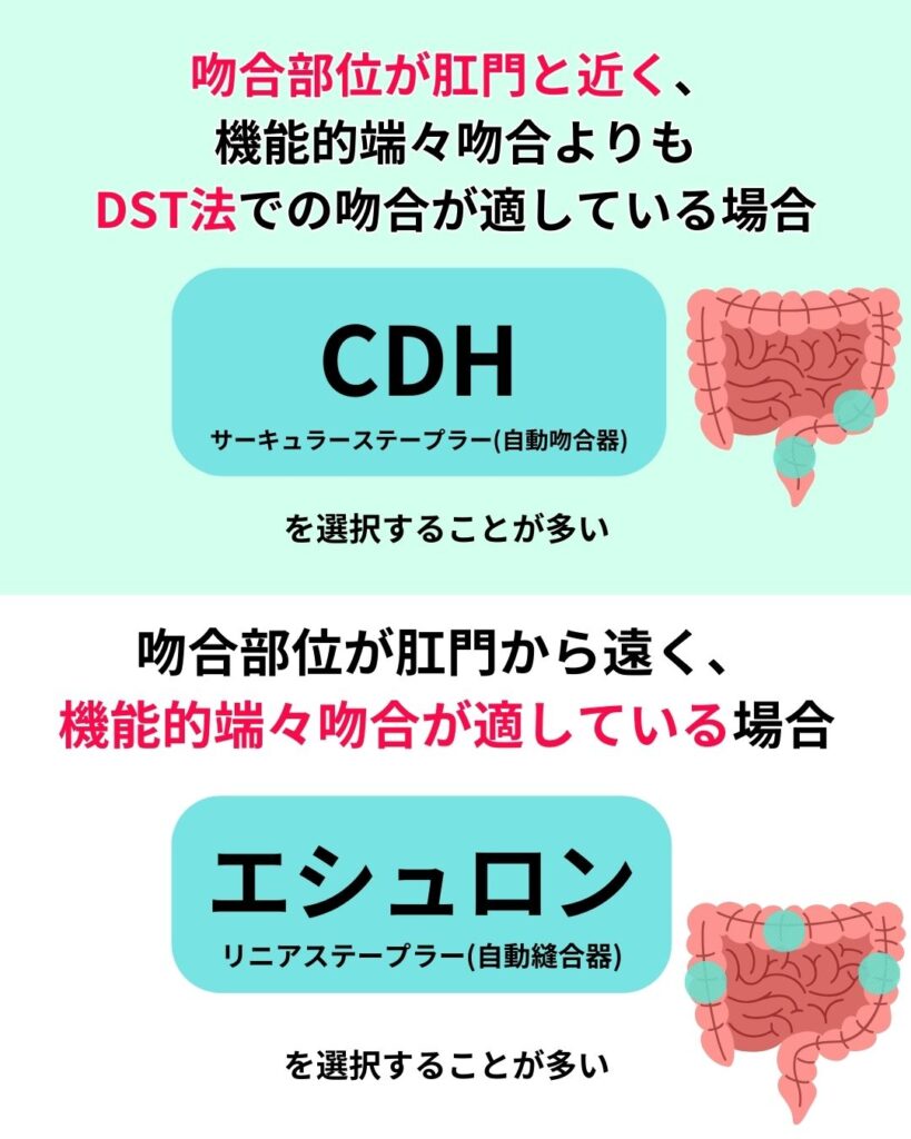 DST法で結腸吻合するのはどのような時？の解説画像
