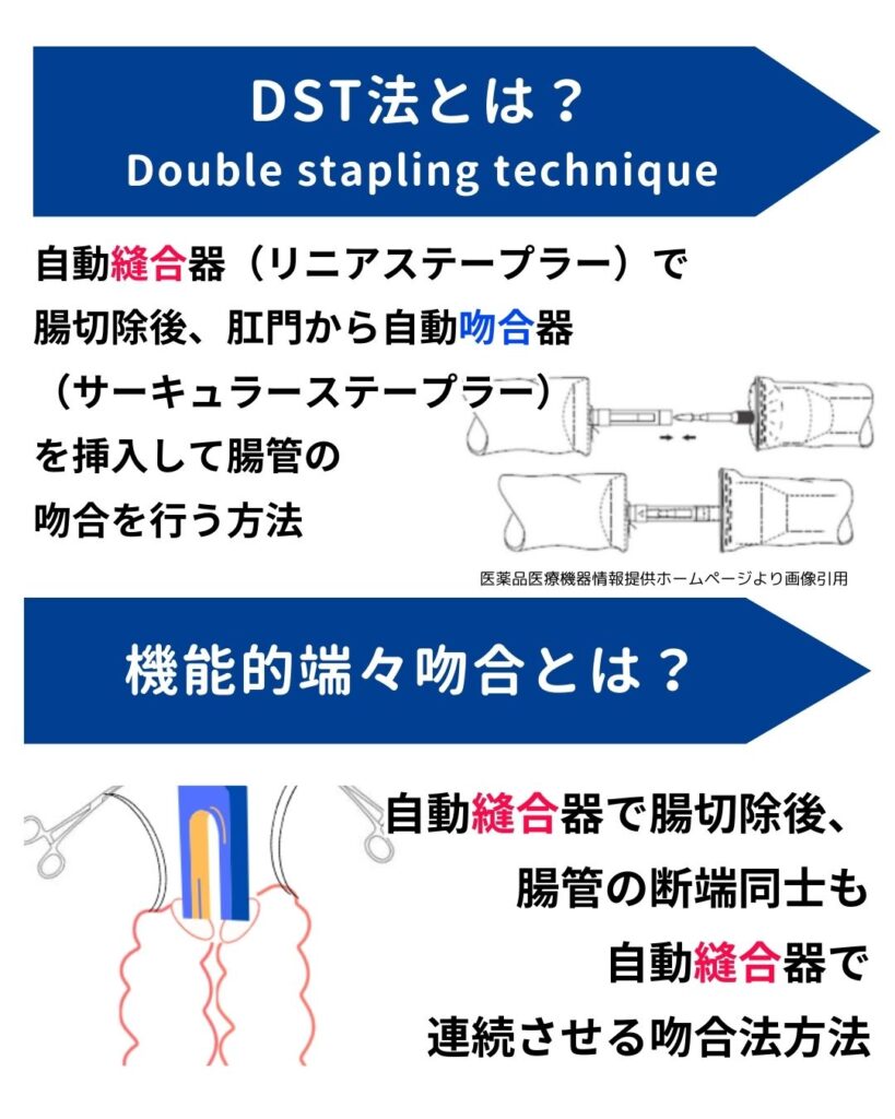機能的端々吻合とDST法の違いとは？の解説画像