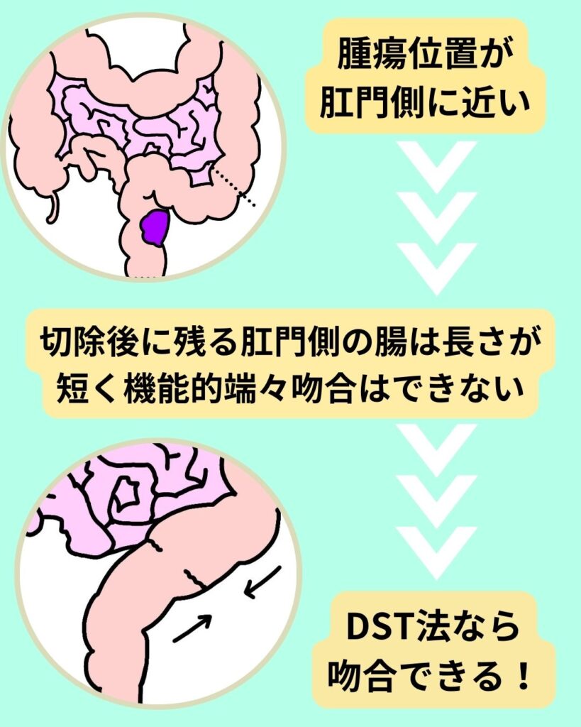 DST法で結腸吻合するのはどのような時？の解説画像