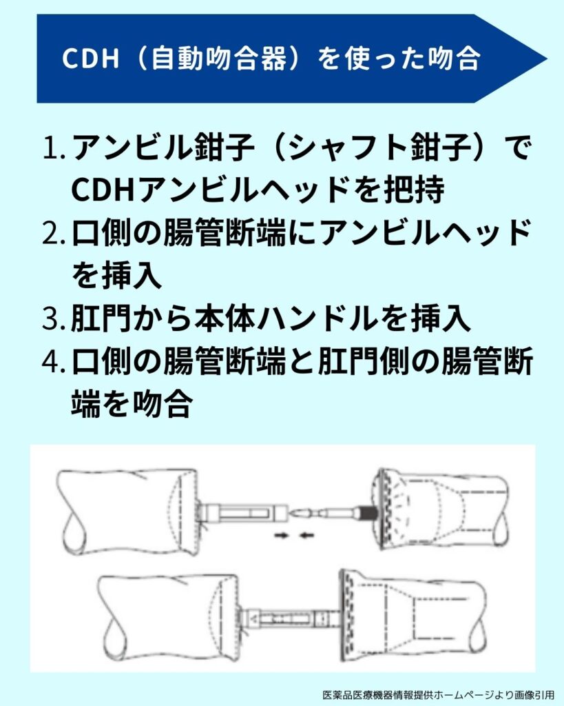 DST法での結腸吻合を行う場合（肛門側からCDHなどの吻合器を挿入して吻合する方法）の解説画像