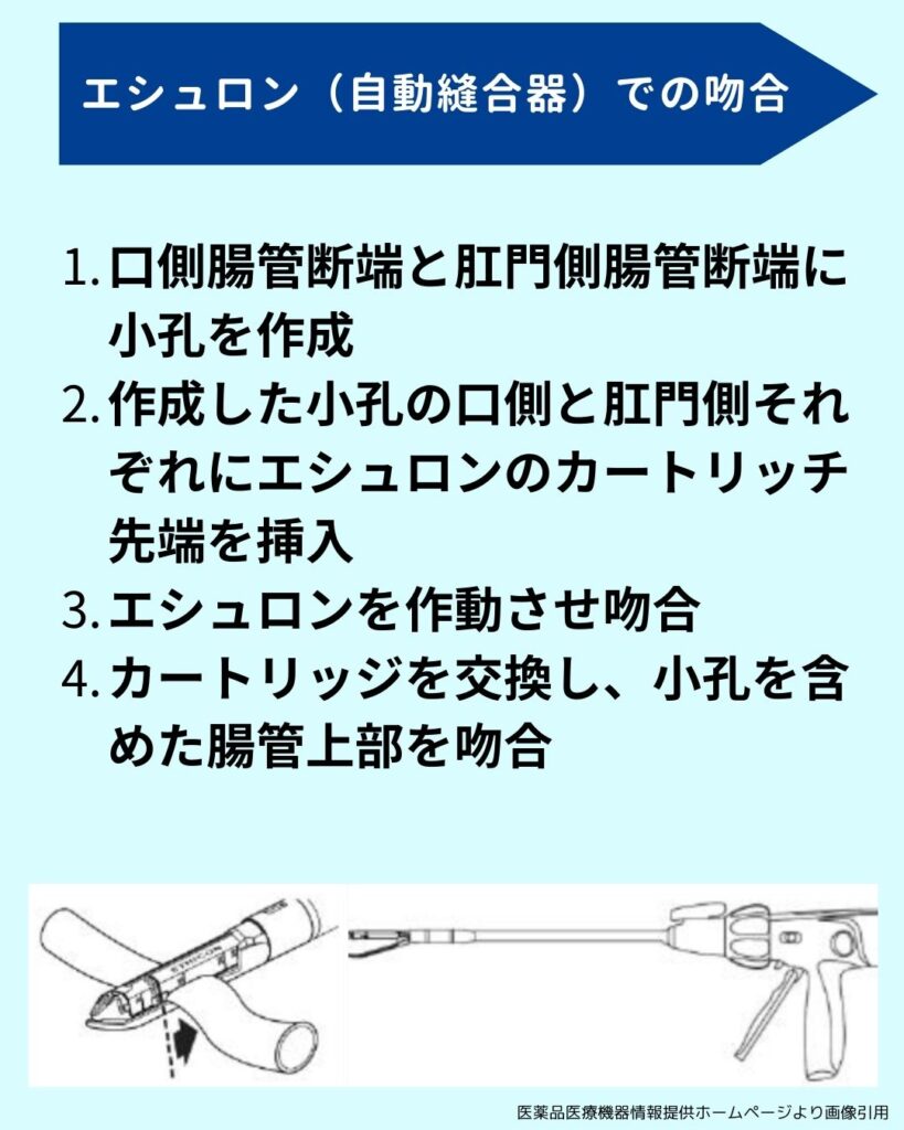 機能的端々吻合にて結腸吻合を行う場合の解説画像
