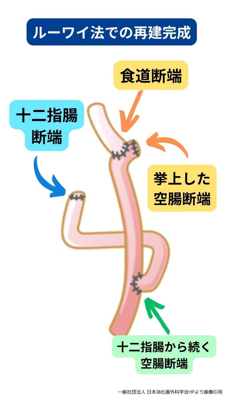 【ルーワイ法のわかりやすい解説】胃全摘術の手術手順と再建方法をオペ看向けに解説! | 【オペ看が楽しくなる!】