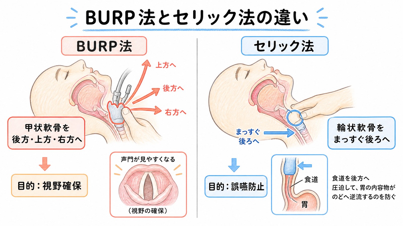 BURP法とセリック法の違いの図。BURP法は甲状軟骨を後方上方右方へ動かして視野を確保し、セリック法は輪状軟骨をまっすぐ後ろに押して誤嚥を防ぐ