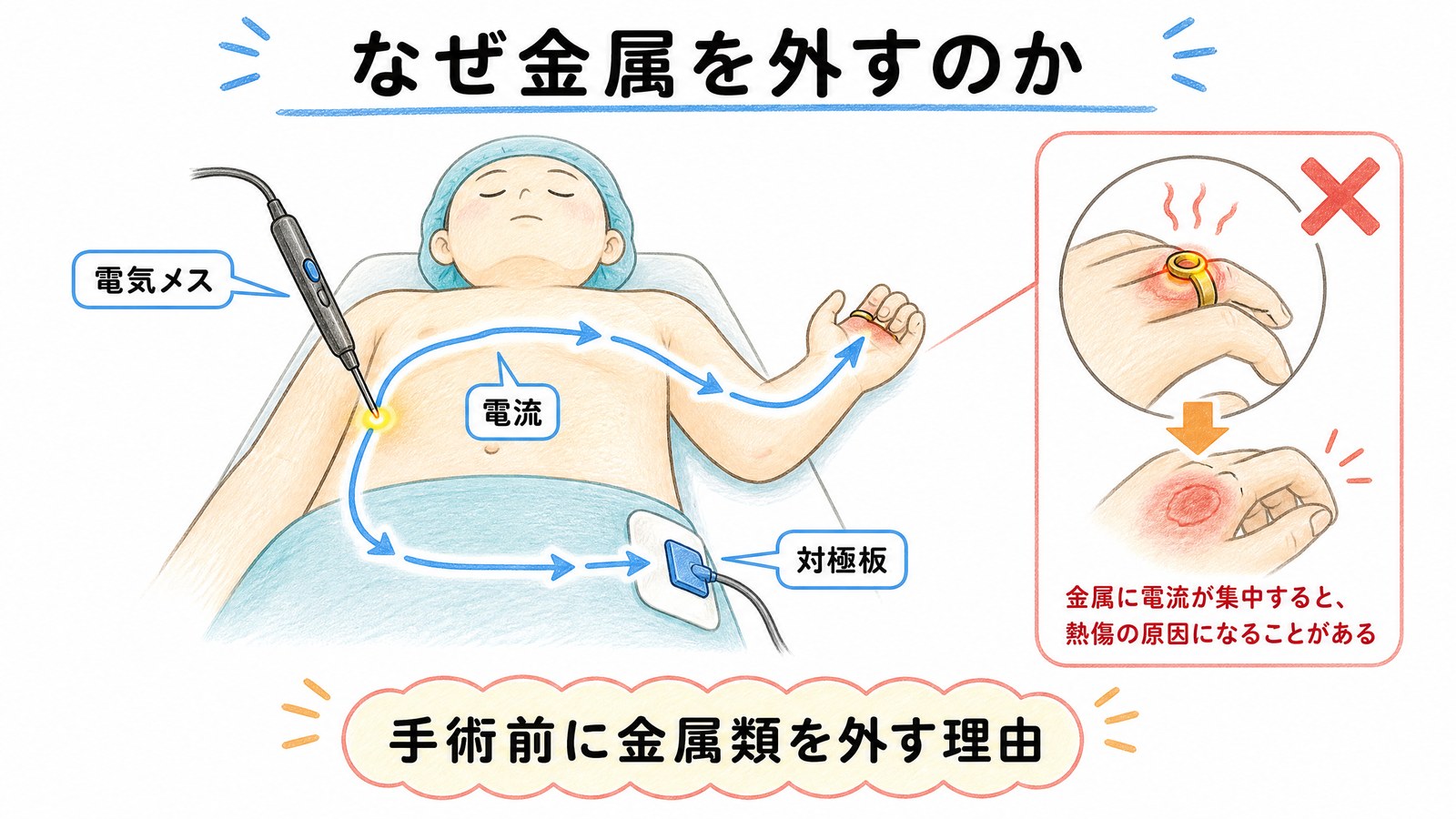 電気メスの電流が体を通って対極板へ戻る経路の図。途中に金属があると電流が集中し熱傷の原因になることを示す