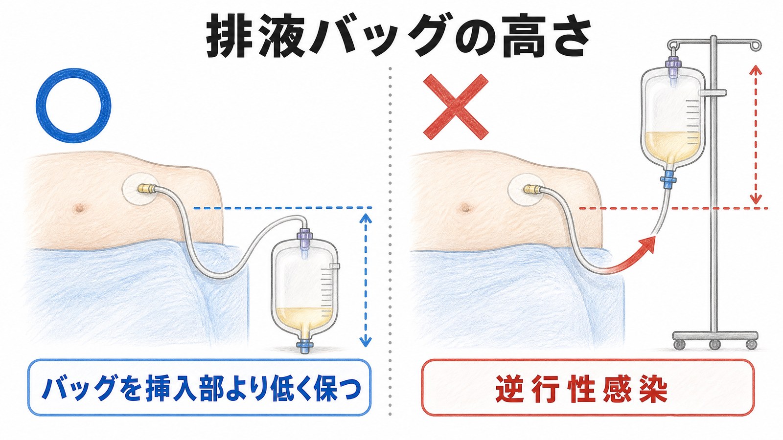排液バッグを挿入部より低く保つ正しい位置と、高く持ち上げて逆流し逆行性感染を招く誤った位置の比較図