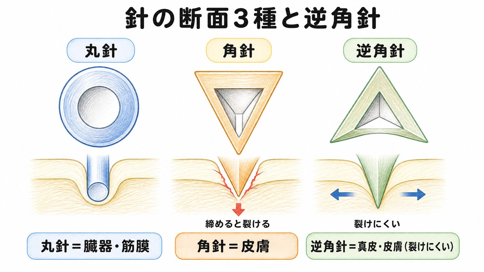 縫合針の断面3種。丸針は臓器・筋膜、角針は皮膚、逆角針は刃が外向きで組織が裂けにくい