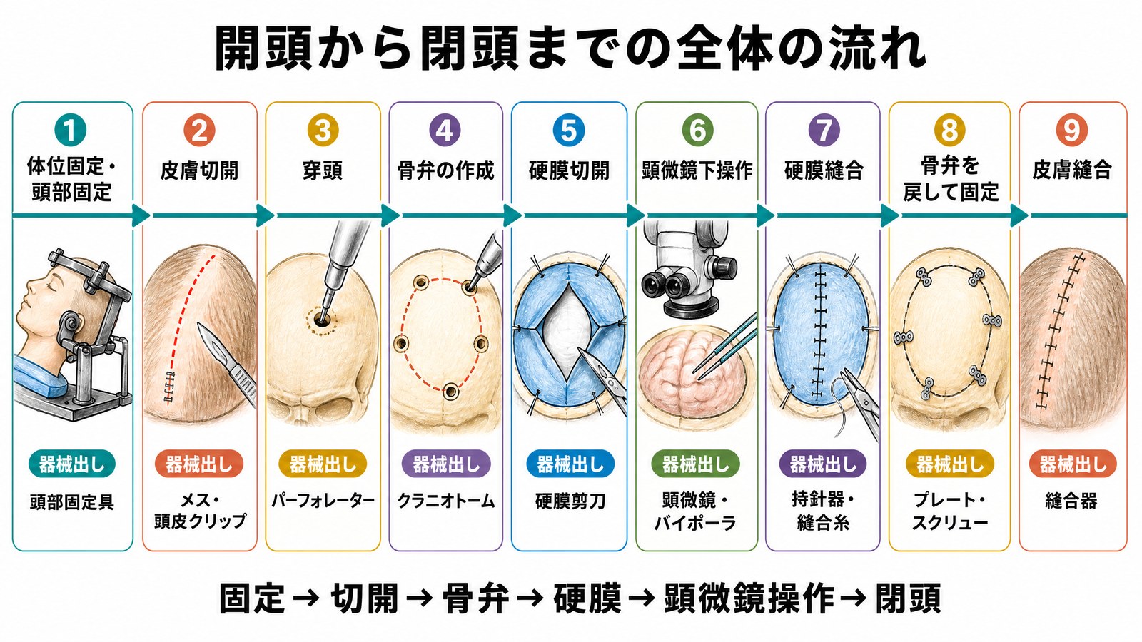 開頭から閉頭までの流れ。体位固定と頭部固定、皮膚切開、穿頭、骨弁の作成、硬膜切開、顕微鏡下操作、硬膜縫合、骨弁を戻して固定、皮膚縫合の9ステップ