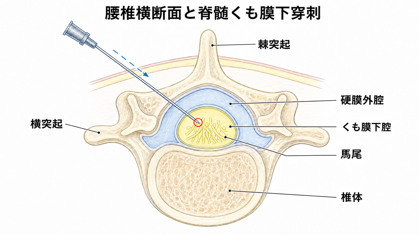 腰椎の断面図。外側から椎体・硬膜外腔・くも膜下腔・馬尾を色分けし、脊髄くも膜下穿刺の針の位置を示した図