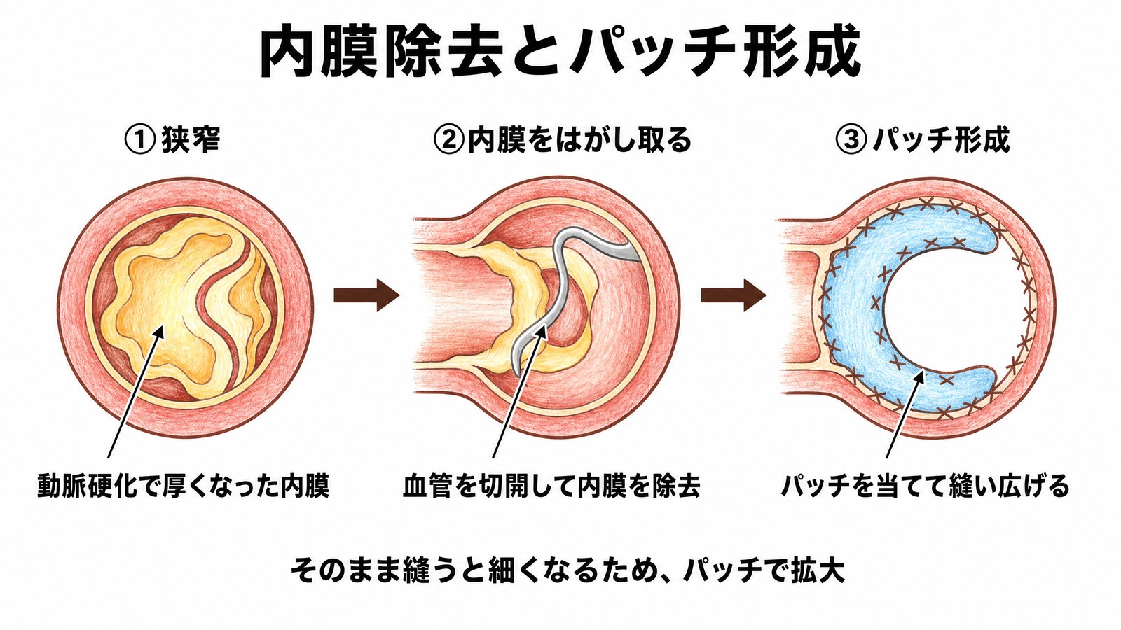 血管内膜除去術とパッチ形成術の仕組み。動脈硬化で厚くなった内膜を取り除き、血管が細くならないようにパッチを当てて縫い広げる