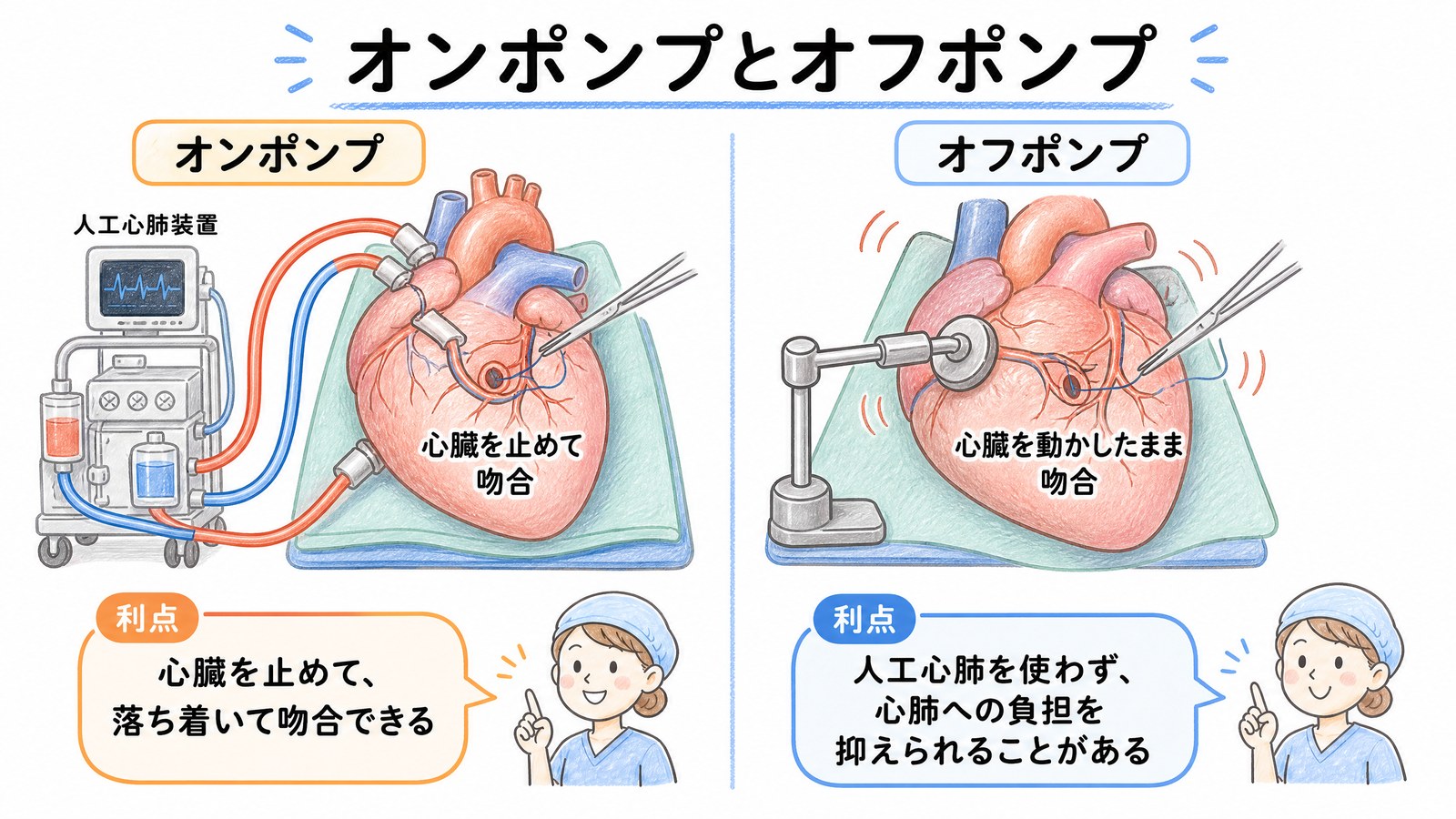 オンポンプとオフポンプの比較図。オンポンプは人工心肺で心臓を止めて吻合、オフポンプは心臓を動かしたままスタビライザーで固定して吻合する