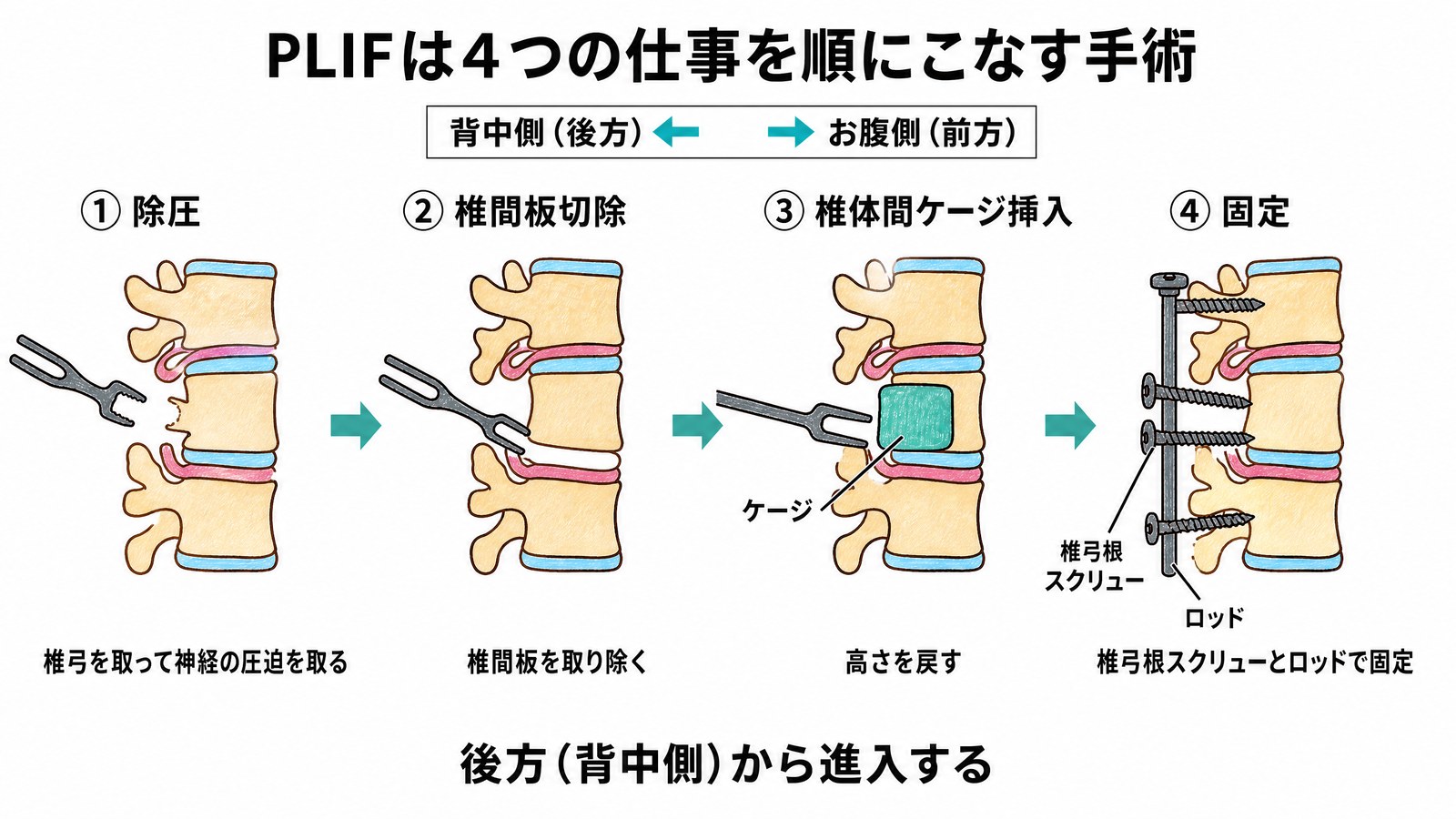 PLIFの4つの仕事を腰椎の側面図で示した図。除圧、椎間板切除、椎体間ケージ挿入で高さを戻す、椎弓根スクリューとロッドで固定の順に進む