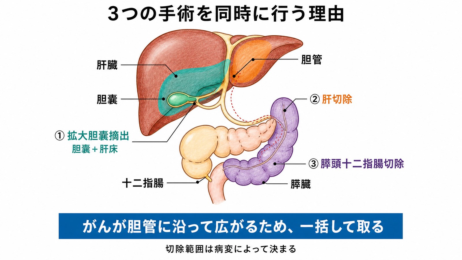 胆管がん・胆嚢がん手術で3つの手術を同時に行う理由の図。胆嚢と肝床、肝臓の一部、膵頭十二指腸の切除範囲を色分けし、がんが胆管に沿って広がるため一括して取ることを示す