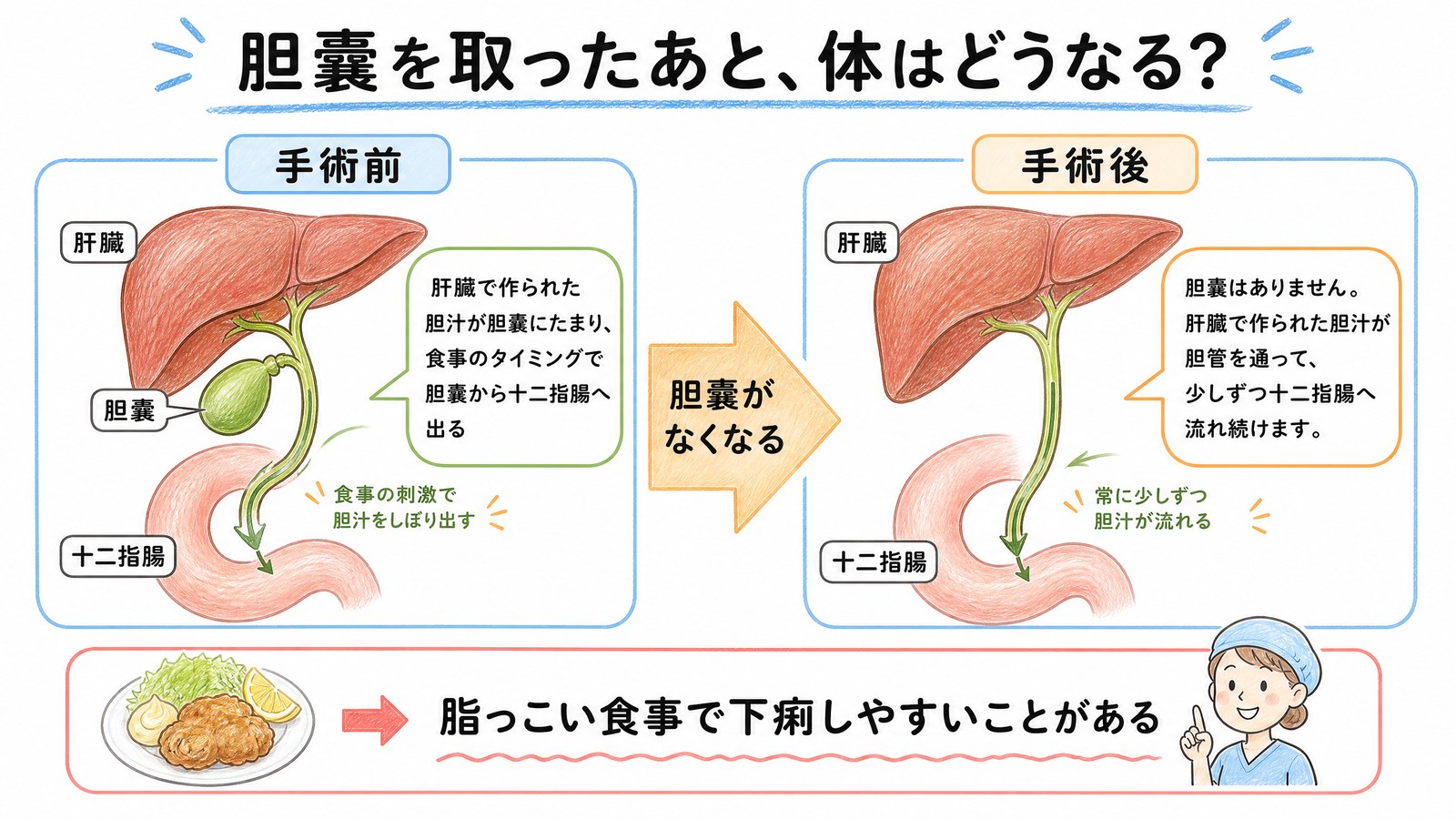 胆嚢摘出前後の比較図。術前は胆嚢に胆汁がたまり食事に合わせて出るが、術後は肝臓から少しずつ流れ続けるため脂っこい食事で下痢しやすい