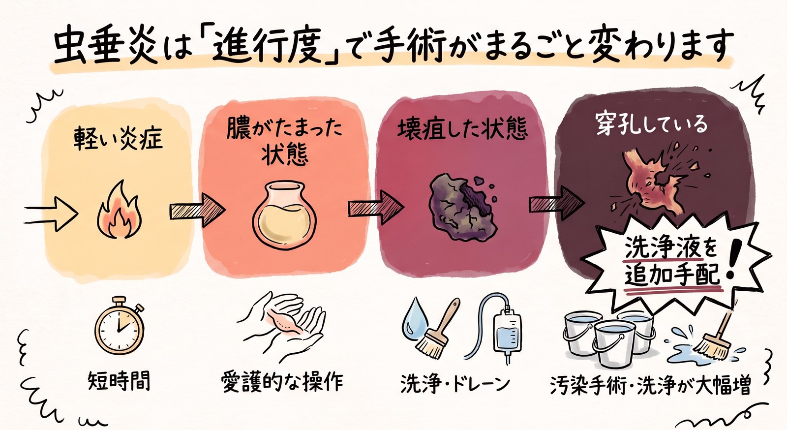虫垂炎の進行度4段階(軽い炎症・膿がたまった状態・壊疽・穿孔)と、それぞれで手術がどう変わるか(短時間・愛護的な操作・洗浄とドレーン・汚染手術で洗浄が大幅に増える)を示した図