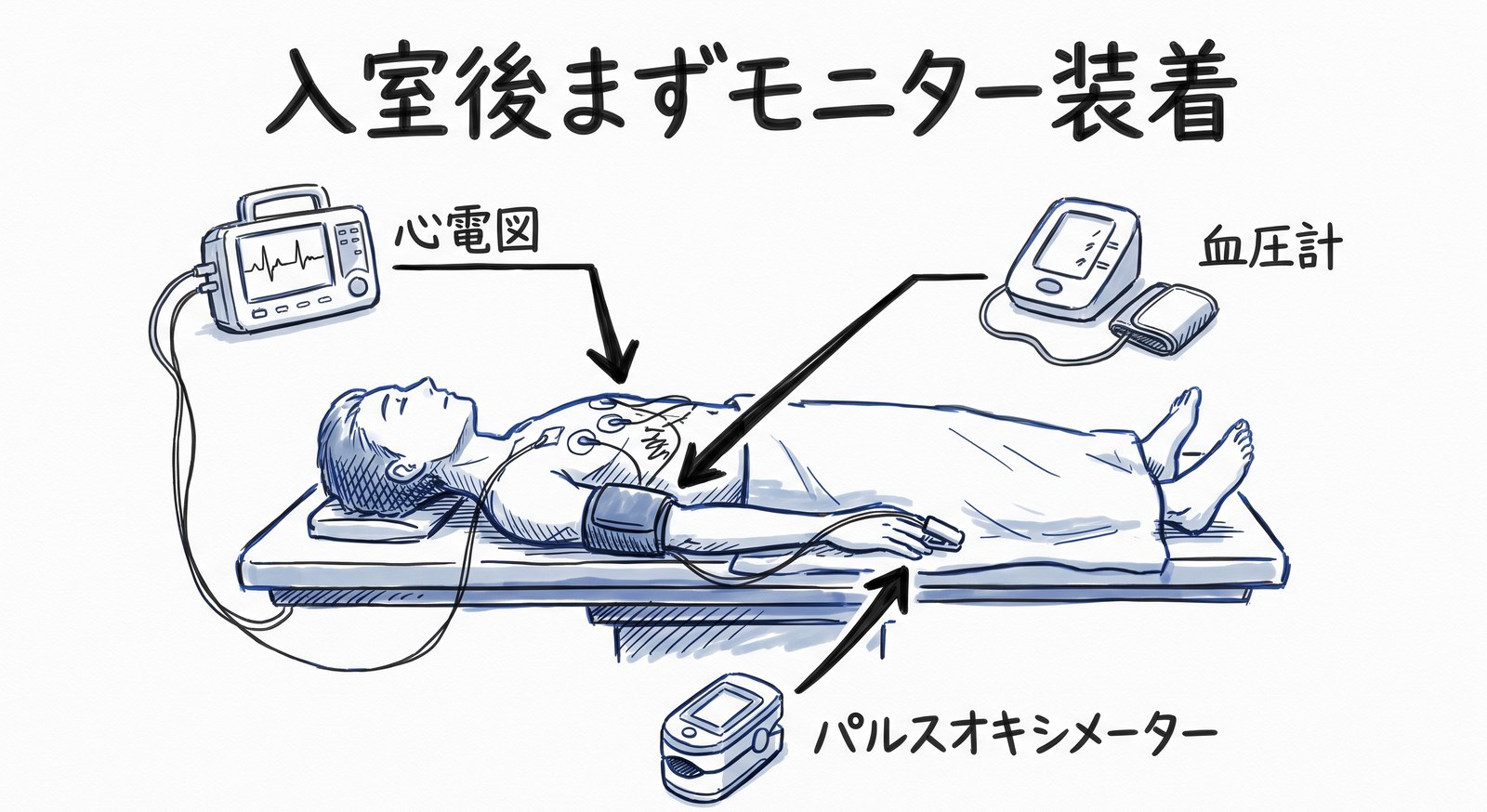 手術台に仰向けの患者さんに、全身麻酔で最初に装着する3つのモニター（上腕の血圧計カフ、胸の心電図電極、指先のパルスオキシメーター）を示した図