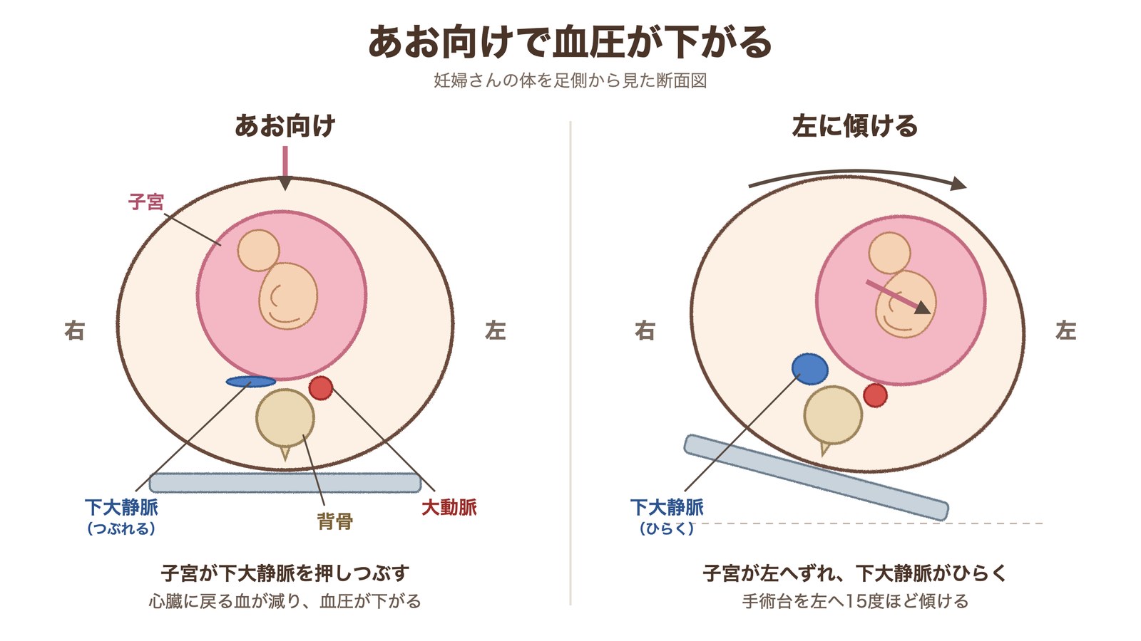 妊婦さんを足側から見た断面図。あお向けでは子宮が下大静脈を押しつぶし、手術台を左に傾けると子宮が左へずれて下大静脈がひらく
