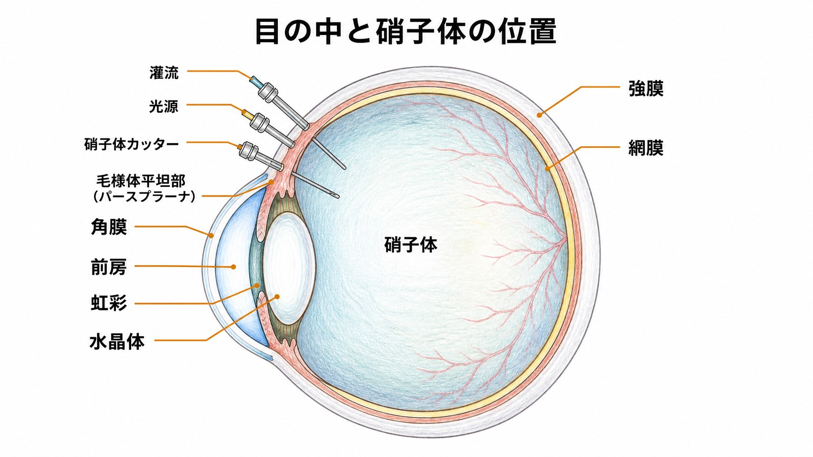 眼球の断面図。前から角膜、前房、虹彩、水晶体、硝子体、網膜の順に並び、硝子体手術では毛様体平坦部に灌流、光源、硝子体カッターの3ポートを作る